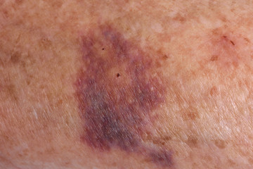 hematoma on the arm of an elderly woman