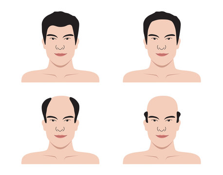 Stages of hair loss . bald man . no hair