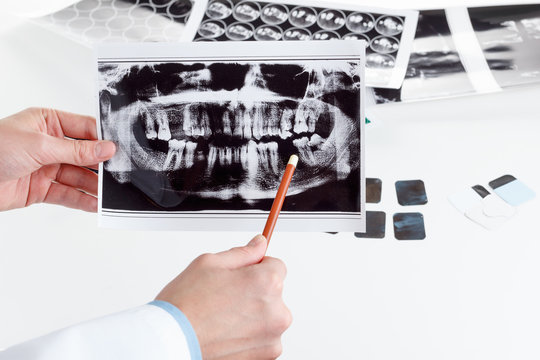 Panoramic dental X-Ray in hand.