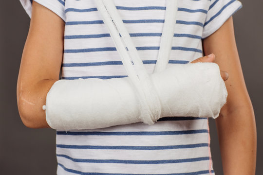  Close-up of a broken arm in a cast on striped shirt  background