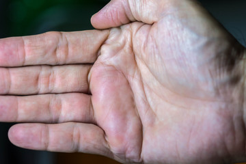 swollen male hand