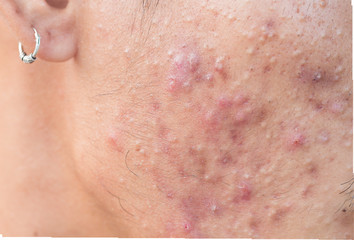 Girl with problematic skin and scars from acne (scar)