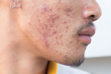 Man with problematic skin and scars from acne (scar)