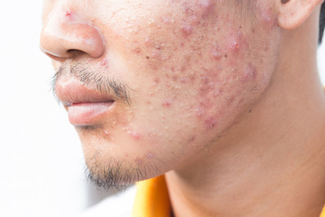 man with problematic skin and scars from acne (scar)