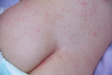 baby with dermatitis problem of rash. Allergy rash suffering from food allergies. Close-up atopic dermatitis symptom on skin of cheeks. Allergy concept