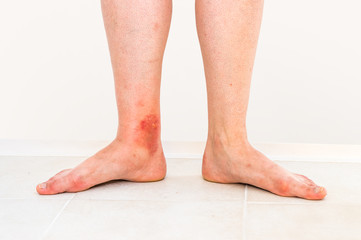 Red rash on leg of patient who was bitten by an insect