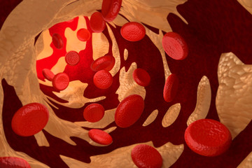 Arteriosclerosis by Cholesterol Plaque, 3D Rendering