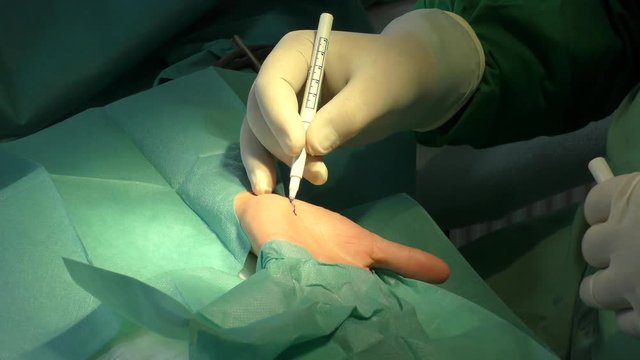 Ein Chirurg f&uuml;hrt eine Karpaltunnel-Syndrom-OP durch