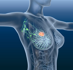 Breast cancer, lymphatics, mastocarcinoma - obrazy, fototapety, plakaty