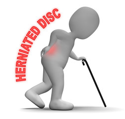 Herniated Disc Indicates Vertebral Column And Backache 3d Render