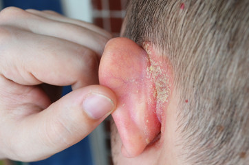 Naklejka premium Psoriasis behind the ear, psoriasis on the nails, pushes the ear, dermatological problems, skin diseases