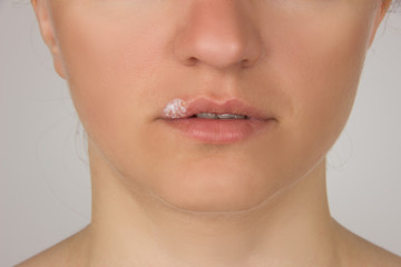 Obraz premium Herpes sore with pus on the lips of the young beautiful girl and