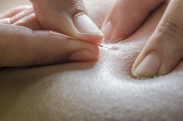 Closeup of a needle and hands of physiotherapist doing a dry needling.