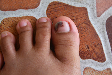 Foot with bruise on nails