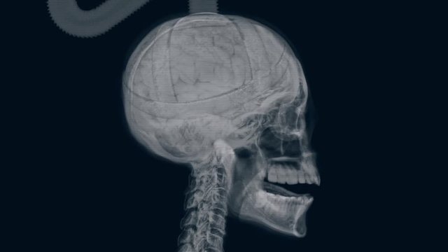 X-ray of electrocuted head.