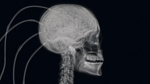 X-ray of experimental procedure on human brain.