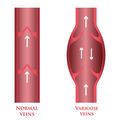 vector varicose veins