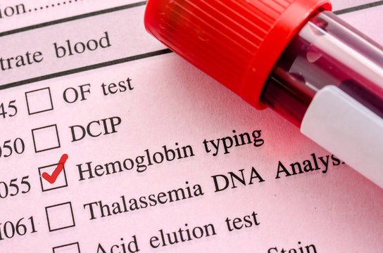 Hemoglobin Typing Test