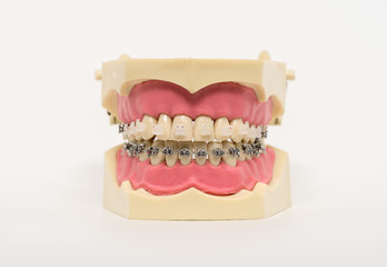 Denture with braces
