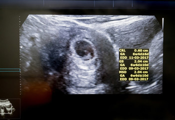 Obstetric Ultrasound of embryo at sixth week
