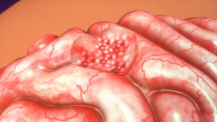 Brain tumor