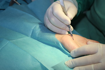 Ein Chirurg führt eine Karpaltunnel-Syndrom-OP durch