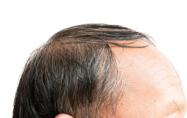 Closeup old man serious hair loss and grey hair problem and for hair loss concept