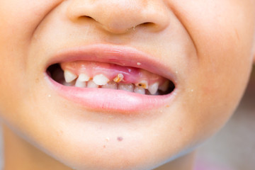 selective focus broken teeth of smiling asian little boy.