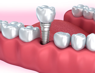 Tooth human implant, Medically accurate 3D illustration
