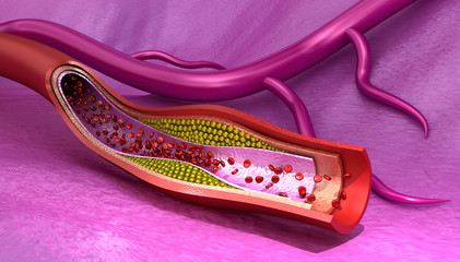 Cholesterol plaque in blood vessel , Medically accurate 3D illustration