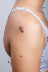 Scar on human skin - 117793464