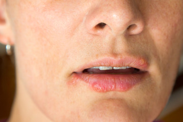 Lippenherpes
