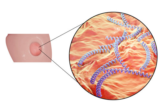Syphilitic ulcer ulcus durum and close-up view of syphilis bacteria Treponema pallidum on the surface of a penis, 3D illustration