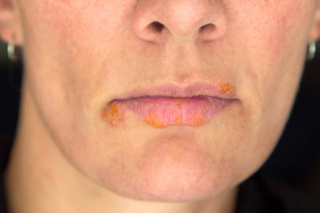 Obraz premium Lippenherpes