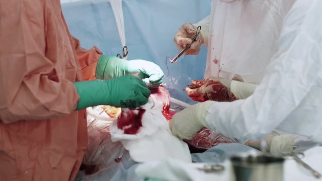 Surgeon sew up stomach of woman by needle and thread. Cesarean section. Hospital. Blood.