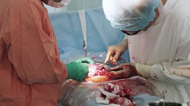 Two surgeons sew up stomach of woman by needle and thread. Cesarean section. Blood. Hospital
