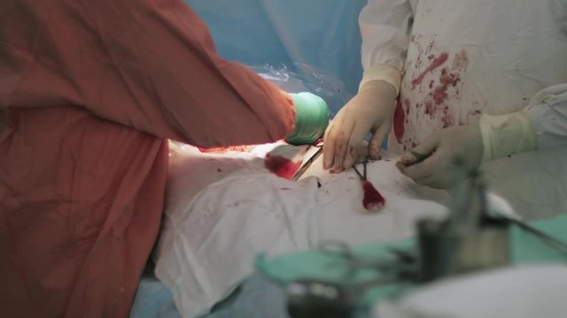 Surgeons sew up stomach of woman in hospital. Cesarean section. Nurse. Blood. Needle and thread