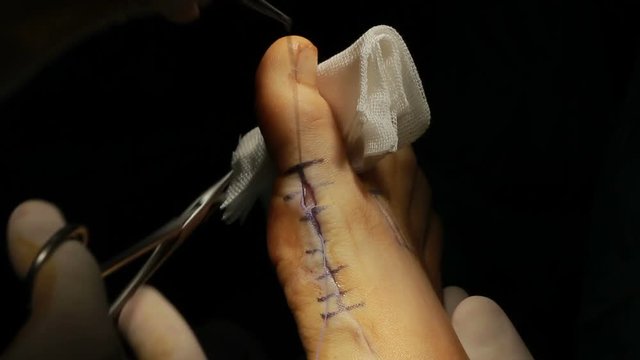 Surgical Stitch