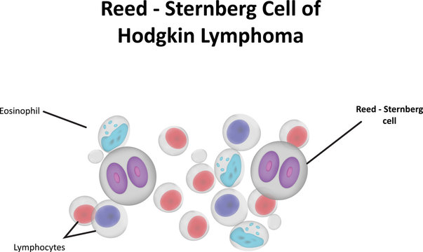 Reed Sternberg Cell