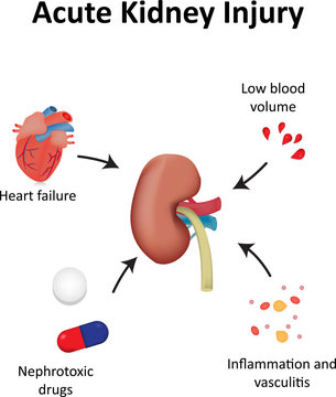 Acute Kidney Injury