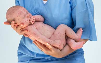 Doctor holding a newborn baby which is sick rubella or measles - obrazy, fototapety, plakaty