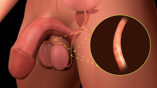 Vasectomy procedure for male sterilization. 