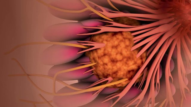 Biomedical visualization of breast cancer/tumor developing and spreading in breast.
