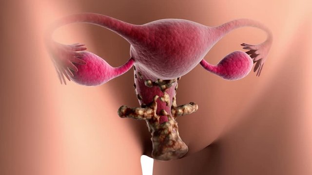 Biomedical visualization of cervical cancer. An infected cell grows & infects other cells of cervix causing tumor, It spreads in & around vagina if not treated.