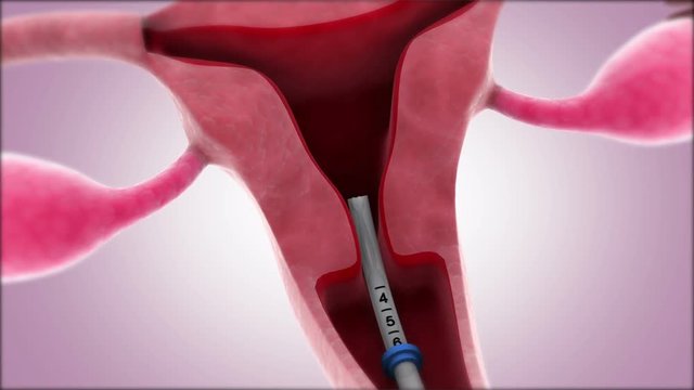 Insertion of an intrauterine device into the uterus.