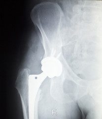 Hip replacement orthopedics implant xray
