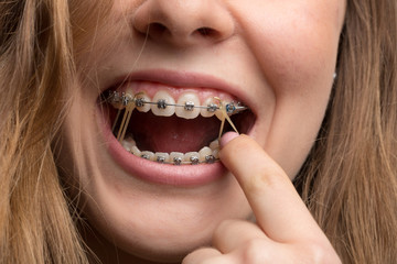 Mädchen mit Zahnspange spannt Gummiband ein