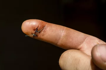 Tuinposter Surgical suture on the finger. © gubernat
