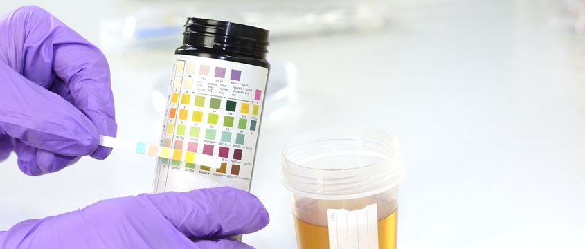 Urinprobe im Labor mit Urinteststreifen