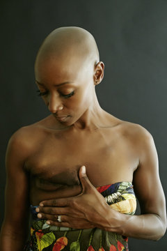 African American cancer survivor showing mastectomy scar